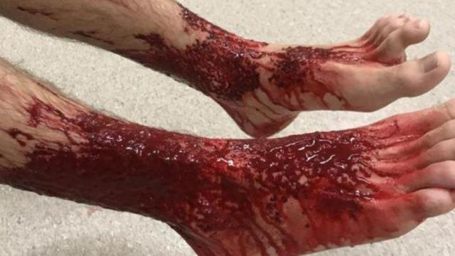 Los pies del joven magullados por las criaturas marinas