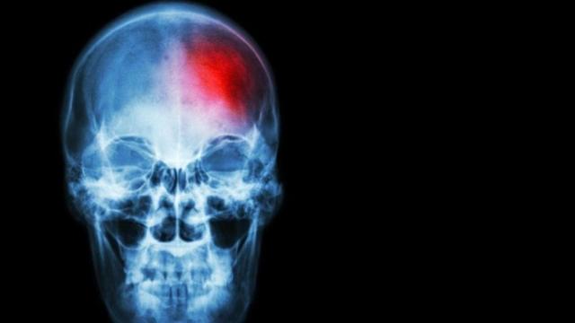 Imagen de archivo de un escáner que muestra un ictus / EP