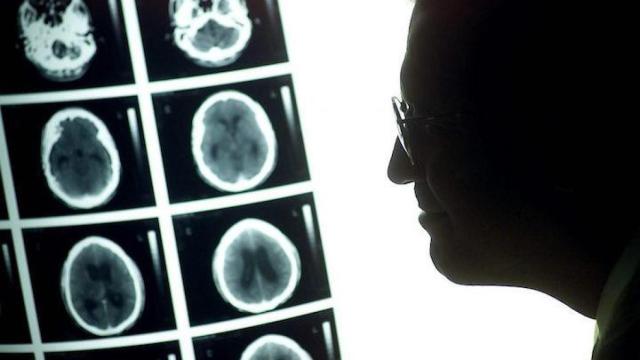 Un tac de un tumor cerebral / EFE