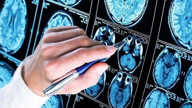 Pruebas de la afectación cerebral de demencia y alzhéimer