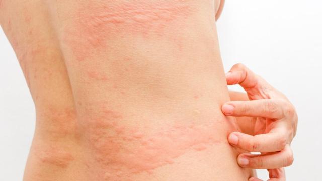 La enfermedad de Kawasaki puede manifestarse con sarpullidos en la piel / EP