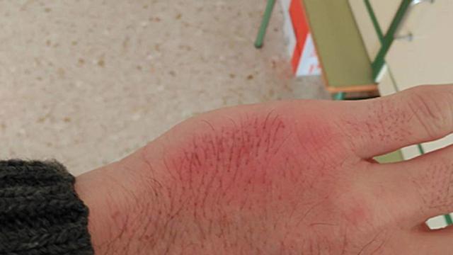 La foto que ha compartido el profesor de su mano contusionada
