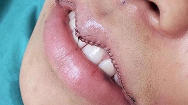 Reducirse los labios es la nueva moda en Asia