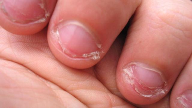 Una foto de archivo de unas uñas mordidas manos