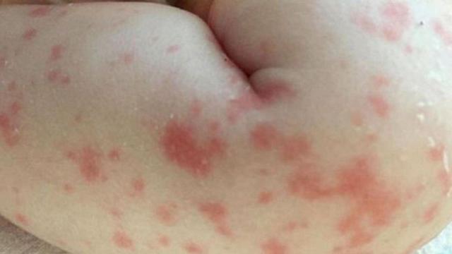 La piel del bebé reveló la infección bacteriana en su cuerpo