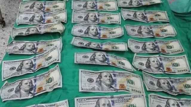 Operaron de urgencia a la mujer y sacaron 7.000$ de su estómago