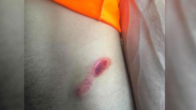 Heridas sufridas tras una agresión homófoba en Barcelona / TWITTER