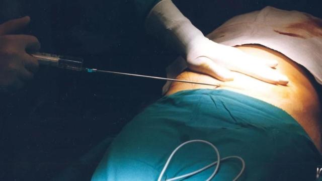 Un médico hace una liposucción / EFE