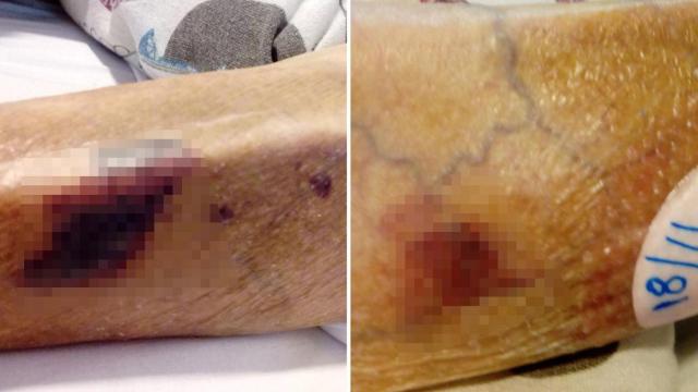 Imágenes de presuntos moratones de una residente en el centro de DomusVi denunciado / CG