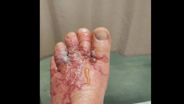 El pie del turista infectado por el parásito