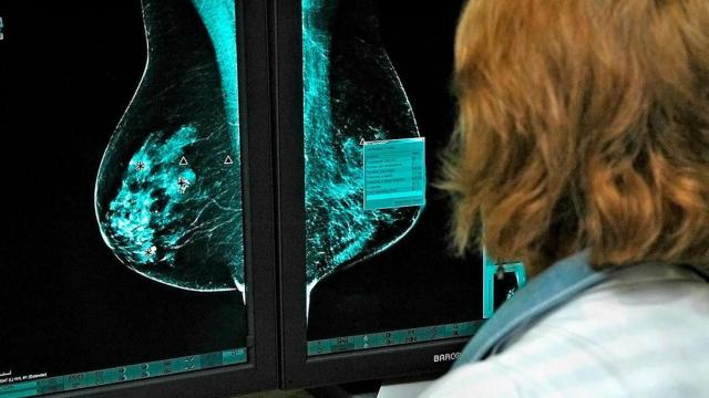 Una doctora analiza una radiografía de un pecho con cáncer de mama / EP