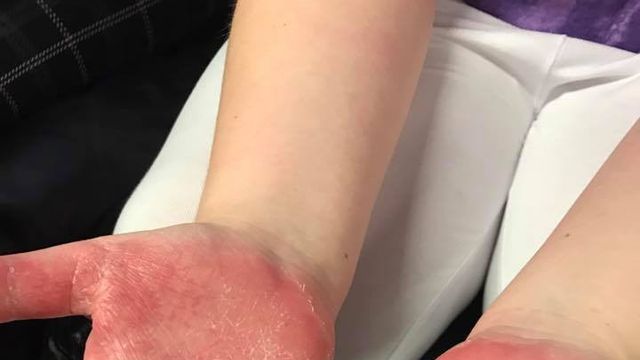 La pequeña sufrió quemaduras por la masa casera en las manos / Facebook