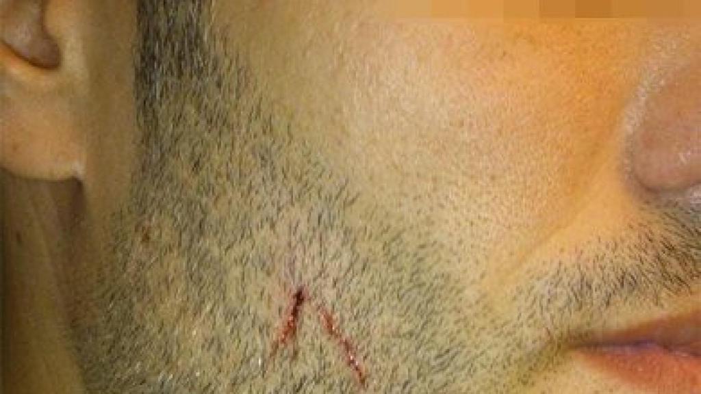 Rostro del agredido por radicales antifascistas· el 12 de octubre en Barcelona