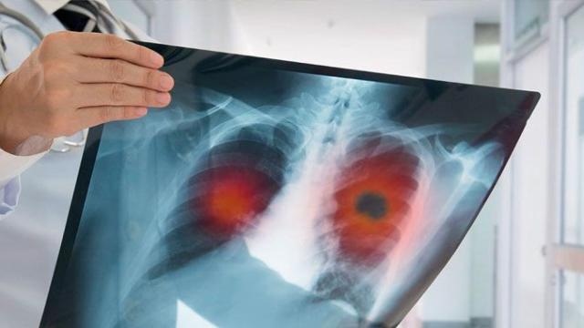 Imagen de la radiografía de un pulmón con un tumor / CG