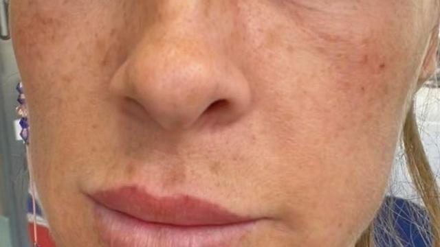 Una mujer con un grano en el ojo / REDES