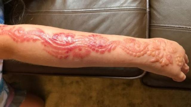 Las quemaduras de la pequeña tras hacerse el tatuaje de henna
