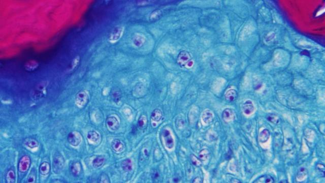 Imagen microscópica de células infectadas por la viruela del mono / EFE