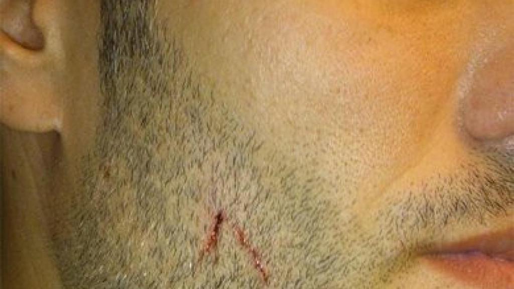 Rostro del agredido por radicales antifascistas el 12 de octubre en Barcelona