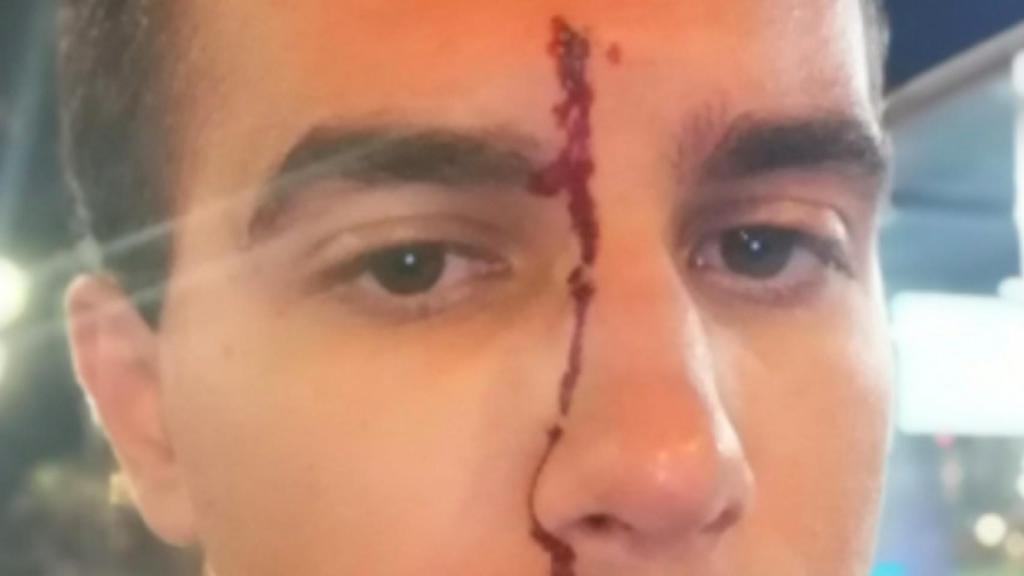 Imagen de la herida ocasionada en la frente tras la agresión homófoba / TWITTER