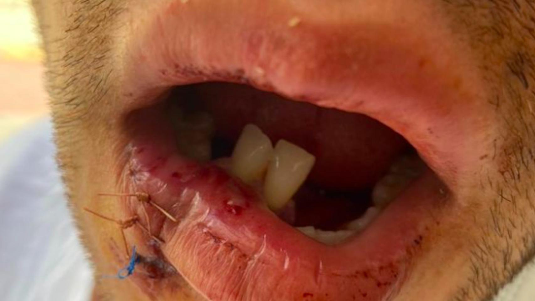 Boca del joven agredido en un acto homófobo en la playa del Somorrostro de Barcelona / GOFUNDME