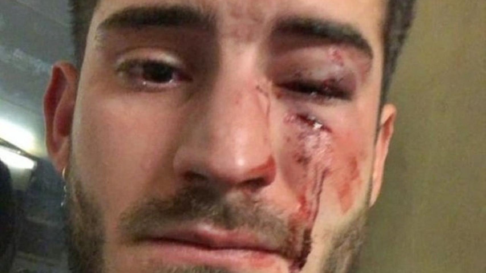 La víctima, Diego Martos, momentos después de la agresión homófoba en 2019 / INSTAGRAM