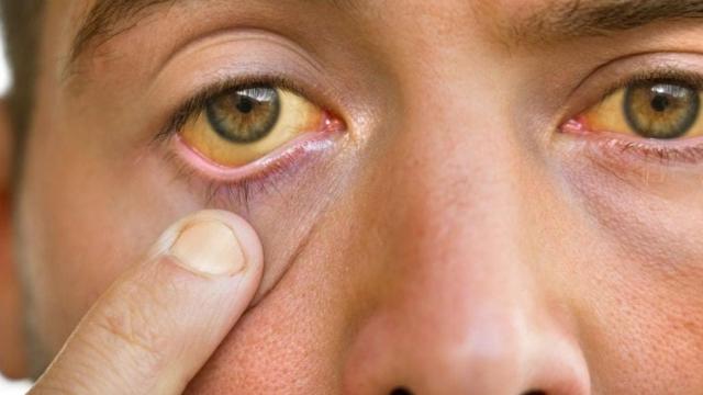 La tonalidad amarillenta del ojo indica que hay algún problema de salud / QUIRÓNSALUD