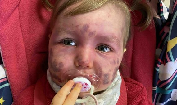 Ariya Cornelius, la bebé con el síndrome de Sturge-Weber / CEDIDA