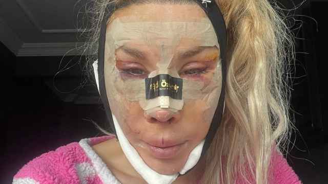 La Pelopony tras una operación