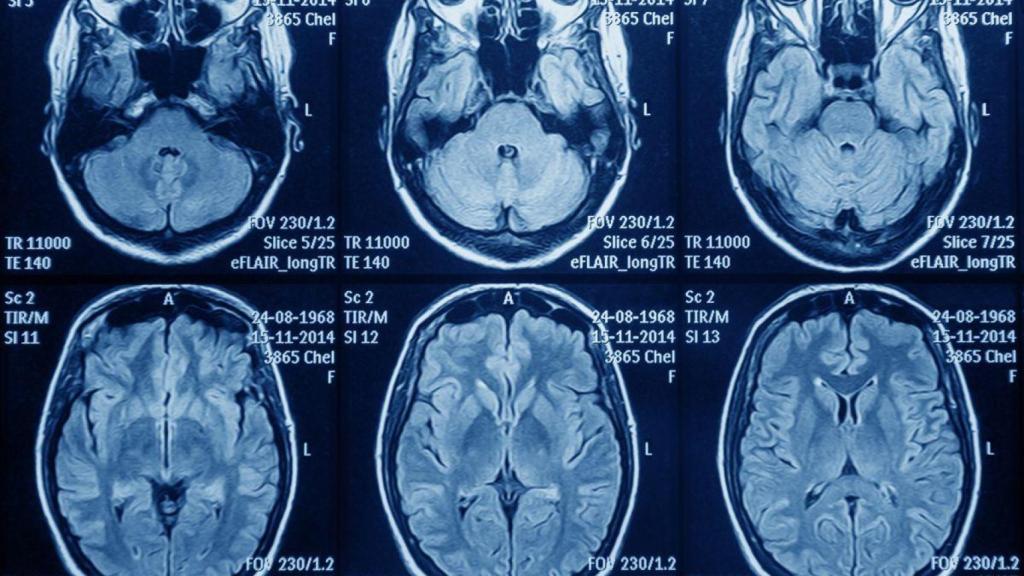 Resonancia magnética del cerebro