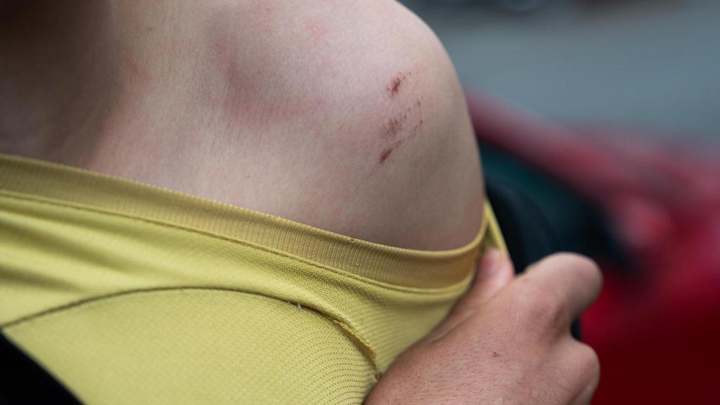 La herida de Mohammed