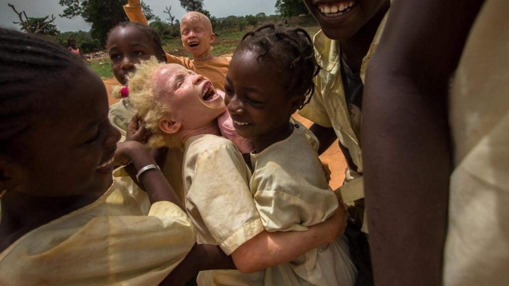 Una niña albina juega con otros niños en África