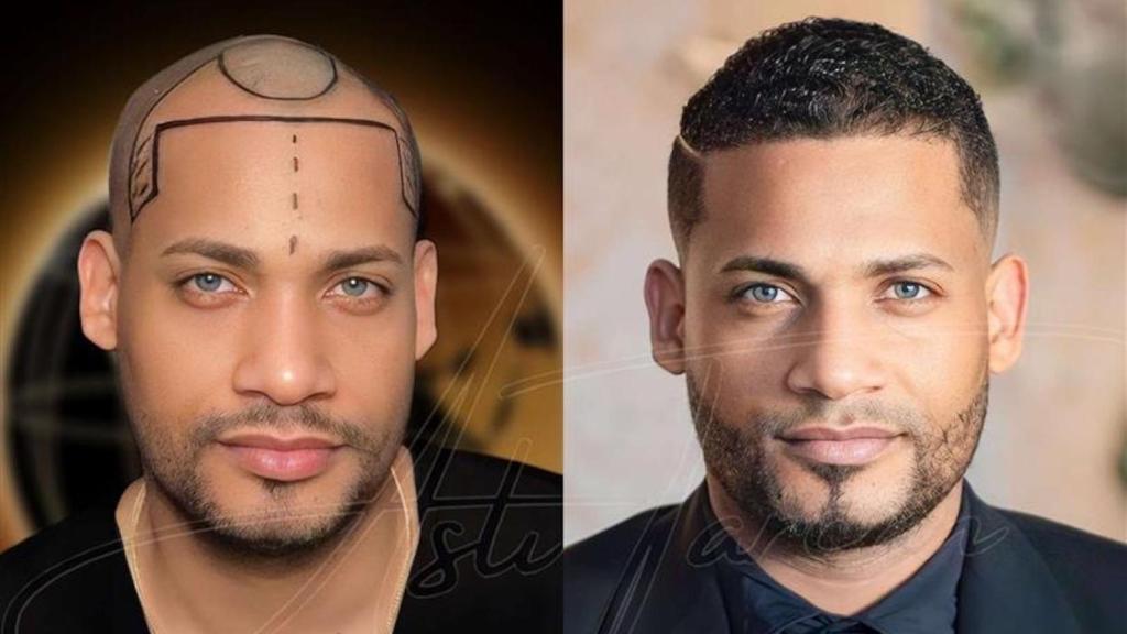 Antes y después de un trasplante capilar en Turquía