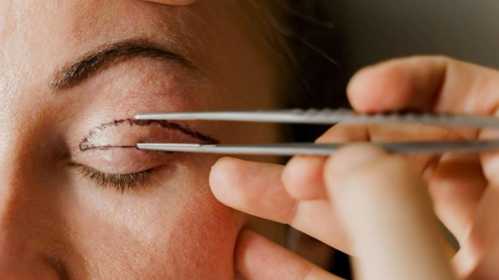 Marcas en el párpado superior hechas por un cirujano