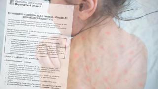 Circular de la Conselleria de Salud sobre el virus del sarampión.