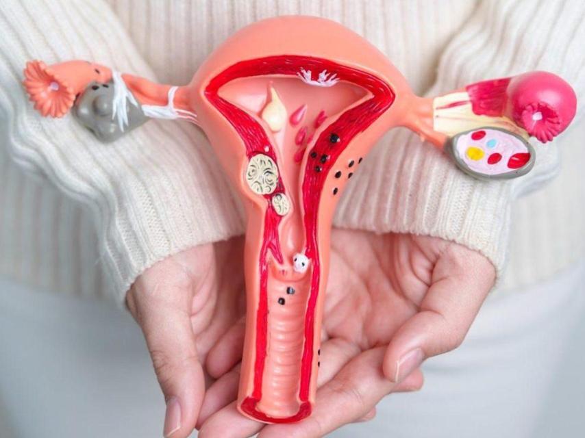 Los quistes de ovario suelen ser tumores benignos asintomáticos compuestos por una masa o un saco lleno de líquido