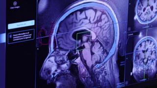 Detección de la zona del cerebro dañada a través de la tecnología HIFU, que se utiliza en el Hospital Sant Pau