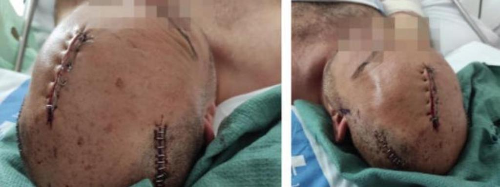 Les ferides que va patir el policia agredit a L'Hospitalet