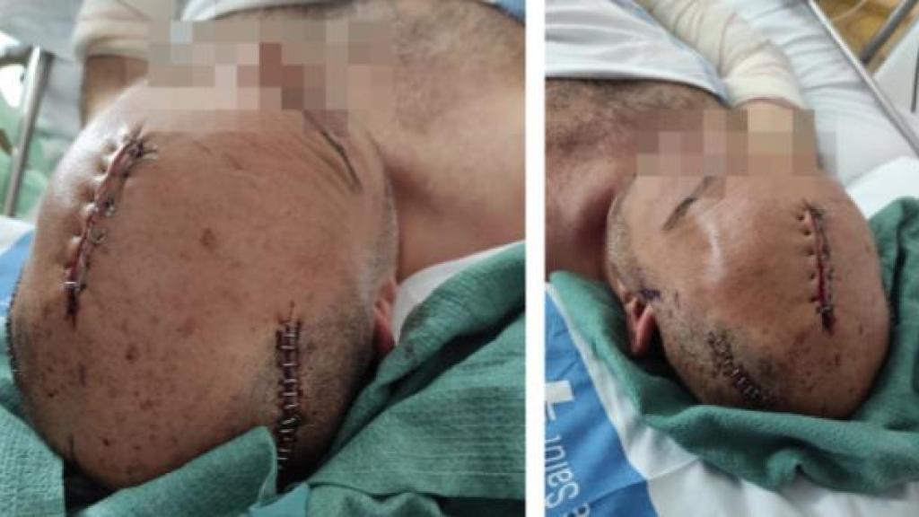 Les ferides que va patir el policia agredit a L'Hospitalet