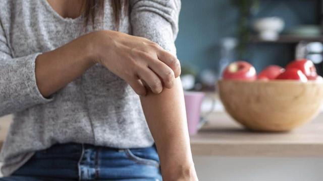 La psoriasis es en realidad una enfermedad que afecta a la piel y que provoca que aparezcan manchas de color rojo./ CV
