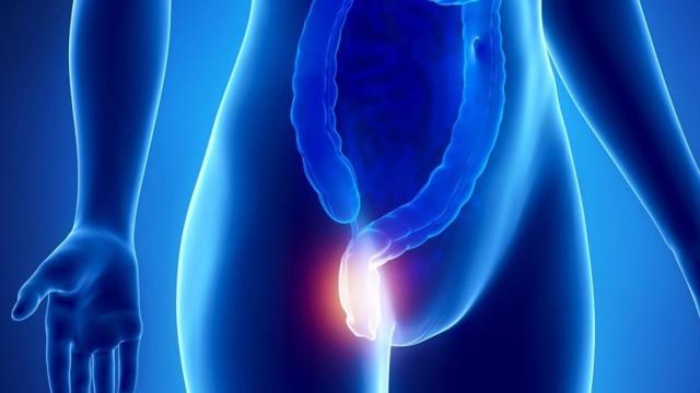 Las hemorroides son una inflamacin de las venas que surgen al final del aparato digestivo / QUIRNSALUD