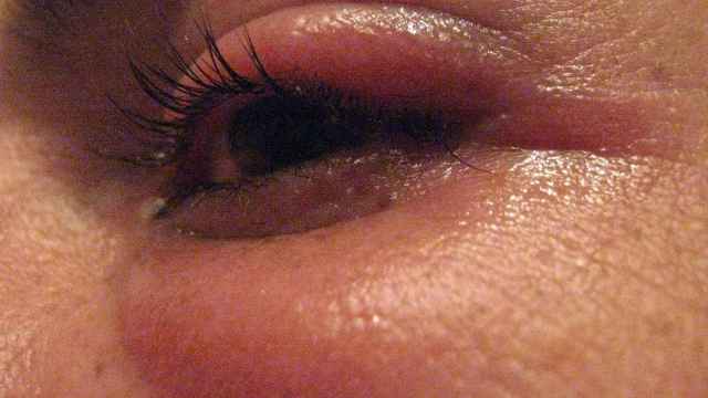 Una mujer padece un orzuelo / WIKIMEDIA COMMONS
