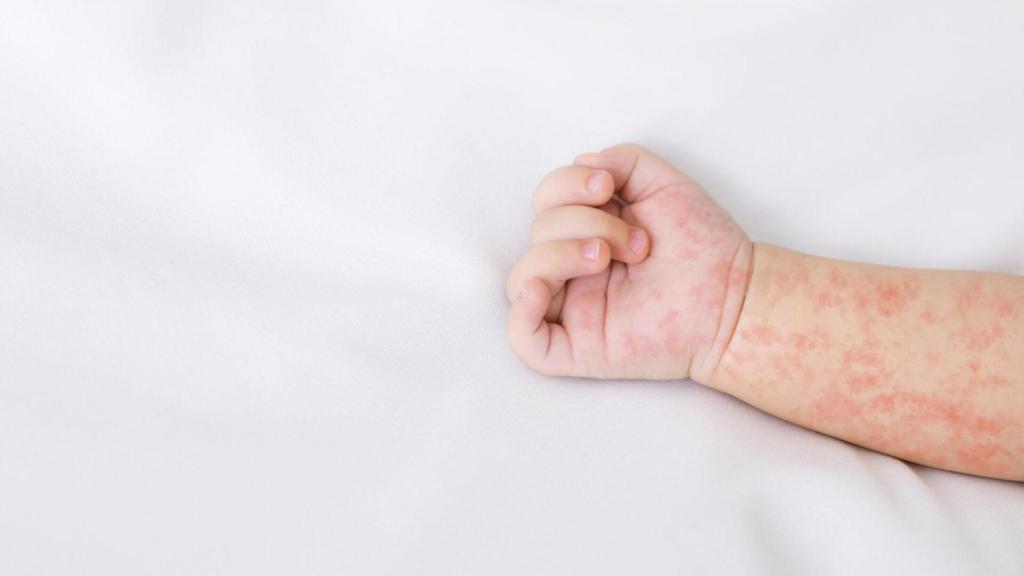 Erupciones en el brazo y la mano de un bebé