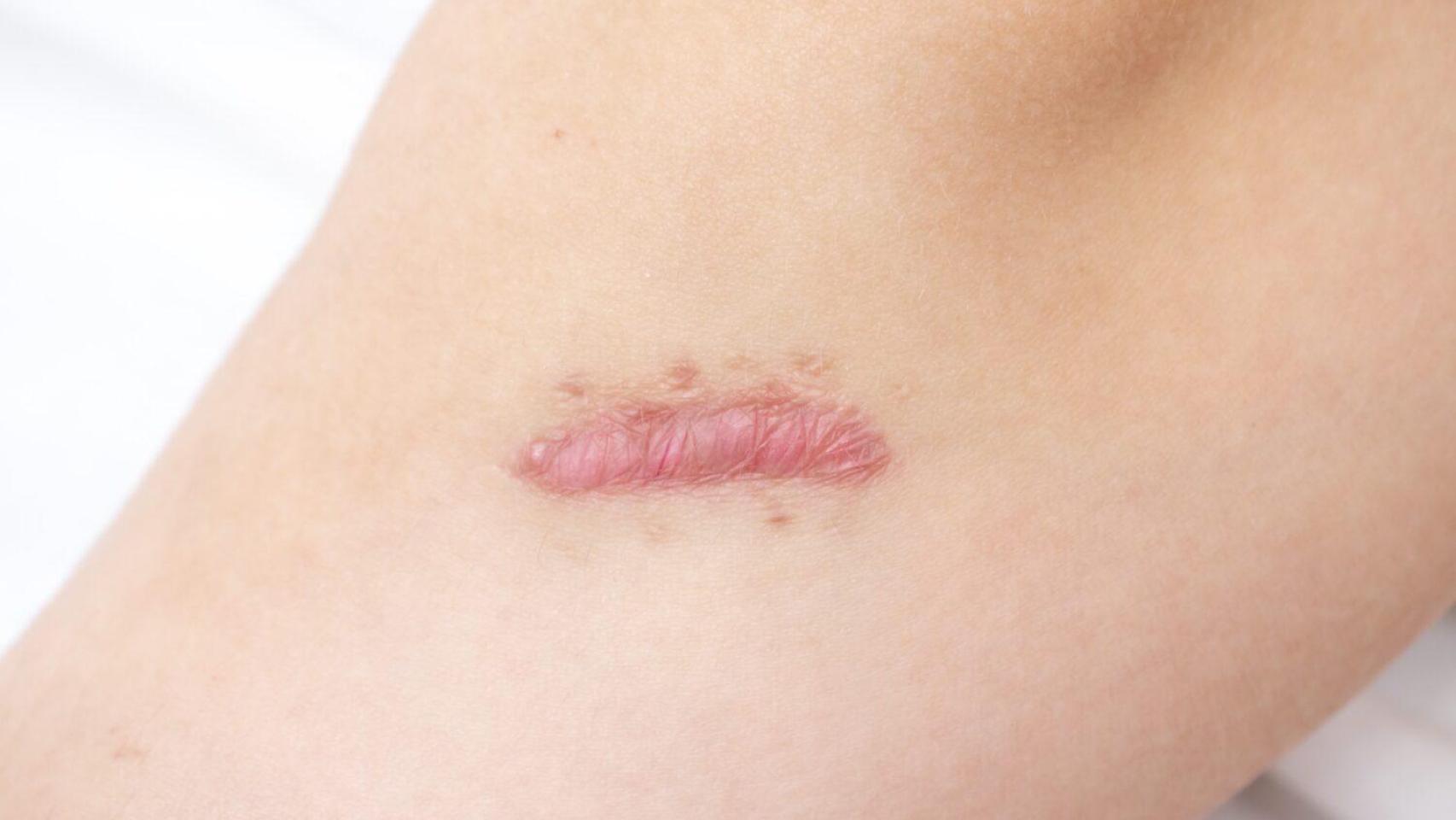 Ejemplo de una cicatriz hipertrófica