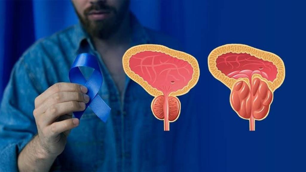 enfermedad de próstata / endolapv