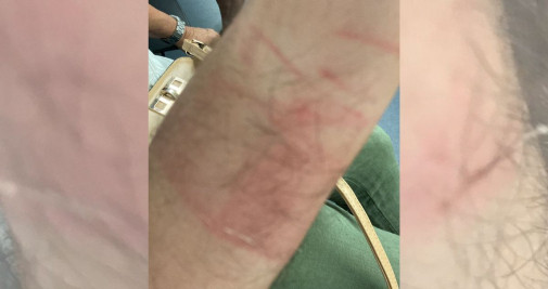 La víctima del robo de un Rólex valorado en 8.000 euros sufrió lesiones en el brazo / VALENTS