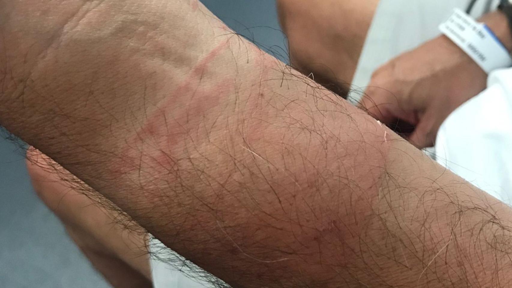 La víctima del robo de un Rólex valorado en 8.000 euros sufrió lesiones en el brazo / VALENTS