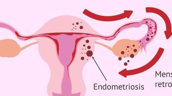 De vegades, l'endometri creix fora de l'úter, principalment als ovaris