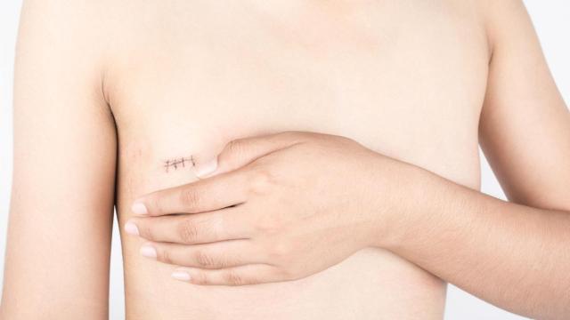 Conservar el pezón es inviable en muchas mastectomías por cáncer de mama / FUNDACIÓN