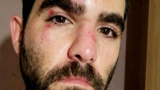 El periodista Robert Calvo, con la cara golpeada / TWITTER ROBERT CALVO