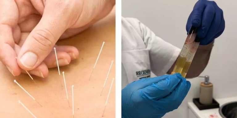 La acupuntura y las infiltraciones de plasma rico en plaquetas son técnicas empleadas en lesiones tendinosas